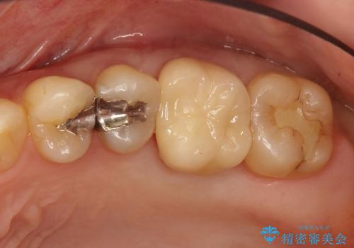 20代女性　深すぎる虫歯に対する歯周外科と被せもの治療の治療後