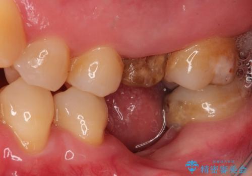 奥歯をインプラントとブリッジで噛めるようにするの症例 治療前