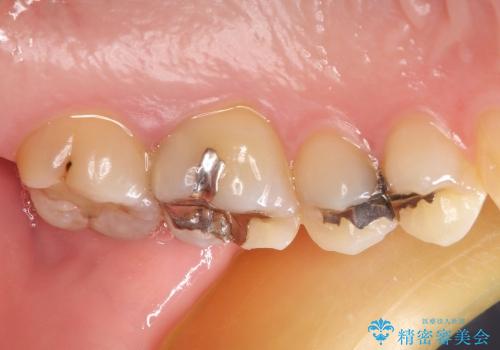 20代女性　深すぎる虫歯に対する歯周外科と被せもの治療の治療前