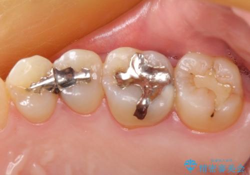 20代女性　深すぎる虫歯に対する歯周外科と被せもの治療の治療前
