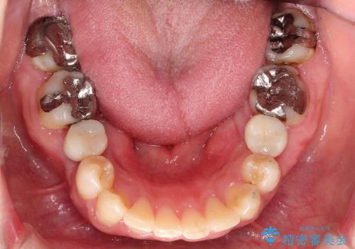 乳歯の晩期残存　永久歯がない　矯正とインプラントによる治療の治療後