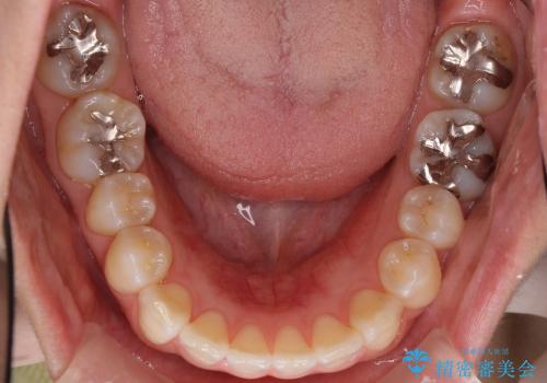 インビザラインで歯を抜かずに八重歯の治療の治療中