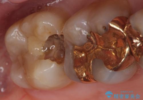 歯が欠けて大きな穴に　セラミックインレー修復の治療前