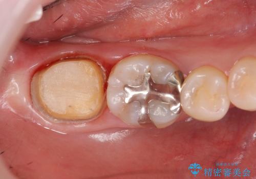 大きな銀歯を白くの治療中