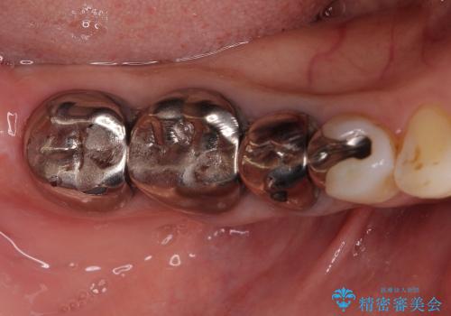 念願のメタルフリー　奥歯の目立つ銀歯を全てセラミックにの治療前