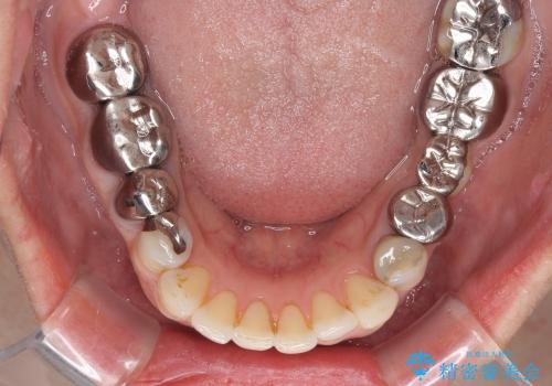 念願のメタルフリー　奥歯の目立つ銀歯を全てセラミックにの治療前