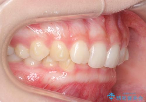 インビザライン　過蓋咬合の治療　ワイヤーでは難しい症例　歯を抜かない治療の治療中