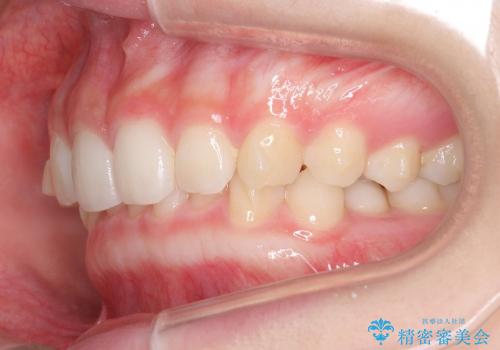 インビザライン　過蓋咬合の治療　ワイヤーでは難しい症例　歯を抜かない治療の治療中