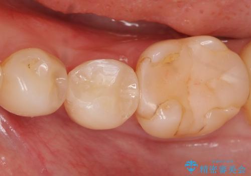 セラミックインレーによる虫歯治療