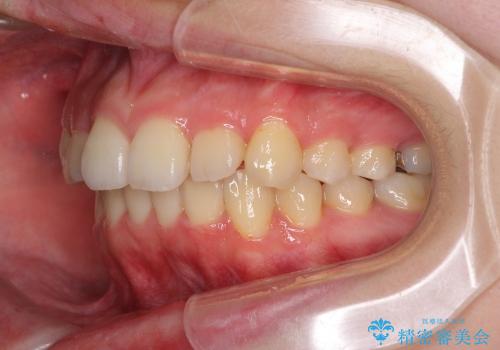 インビザラインによる前歯のでこぼこの改善の治療中