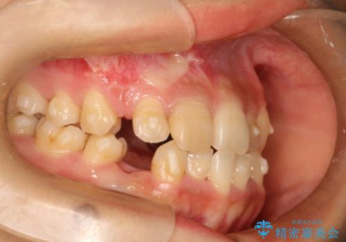 矯正治療に伴う犬歯埋伏抜歯の治療後