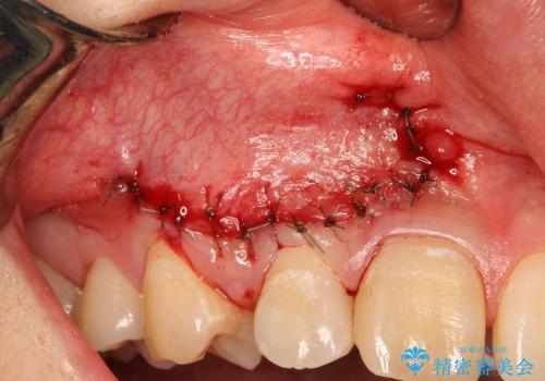 矯正治療に伴う犬歯埋伏抜歯の治療中