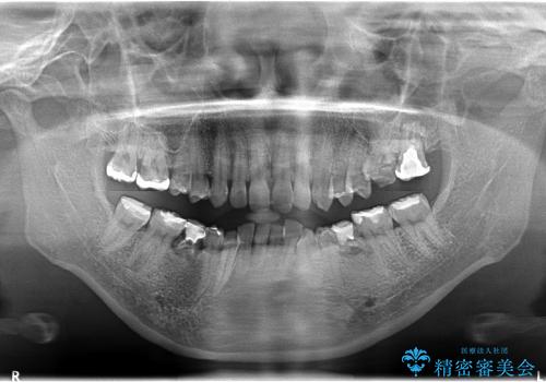乳歯の晩期残存　永久歯がない　矯正とインプラントによる治療の症例 治療前