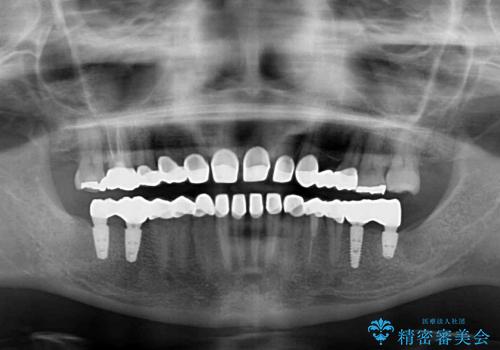 歯の悩みを一気に解決　総合歯科診療の治療後