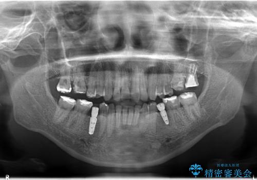 乳歯の晩期残存　永久歯がない　矯正とインプラントによる治療の症例 治療後