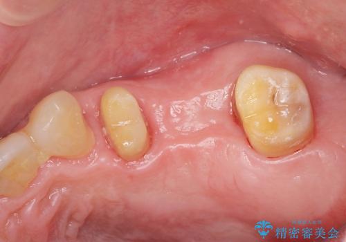 [歯周病治療①] 再生療法→歯周ポケット除去→歯周補綴の治療後