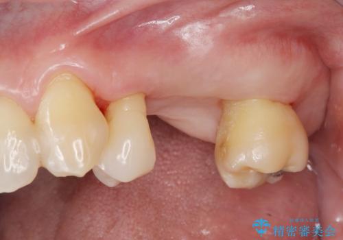 [歯周病治療①] 再生療法→歯周ポケット除去→歯周補綴の治療前