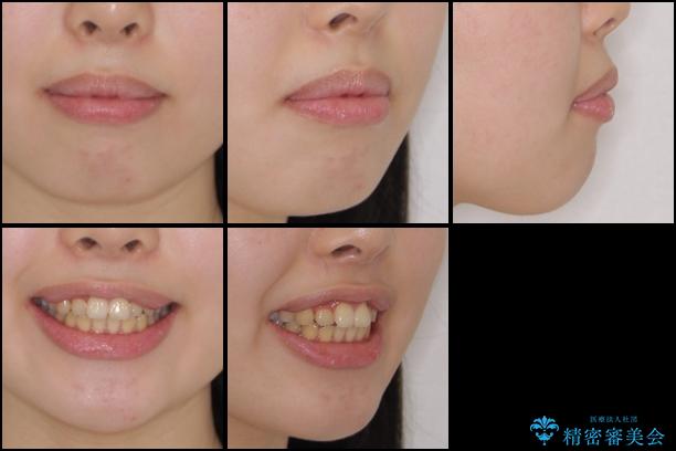 インビザラインによる前歯のでこぼこの改善の治療前（顔貌）