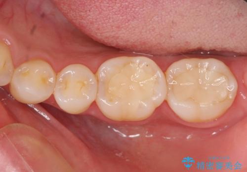 [メタルフリー治療]  銀歯を白く emaxを用いた審美修復・補綴の治療後