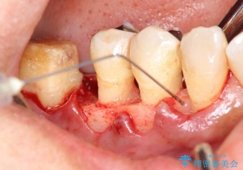 歯を残す歯周病再生治療 ① (再生治療・歯周ポケット除去)の治療中