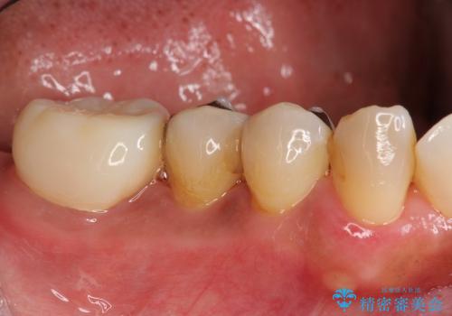 歯を残す歯周病再生治療 ① (再生治療・歯周ポケット除去)の治療前