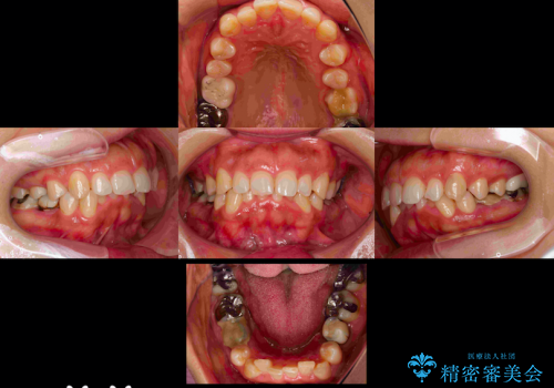 乳歯の晩期残存　永久歯がない　矯正とインプラントによる治療の治療前