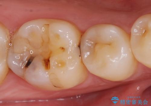 PGA(プラチナゴールド)インレーによる虫歯治療の症例 治療前