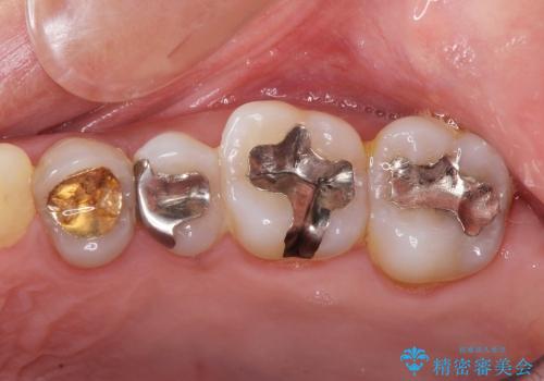 [メタルフリー治療]  銀歯を白く emaxを用いた審美修復・補綴の症例 治療前