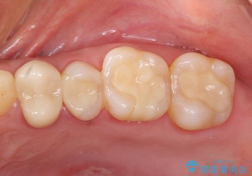 [メタルフリー治療]  銀歯を白く emaxを用いた審美修復・補綴の症例 治療後