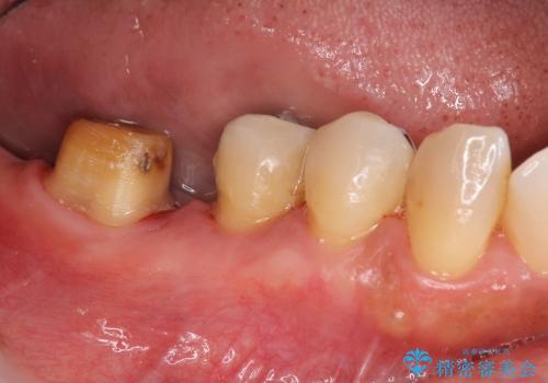 歯を残す歯周病再生治療 ② (歯根分割・歯周補綴)の症例 治療前