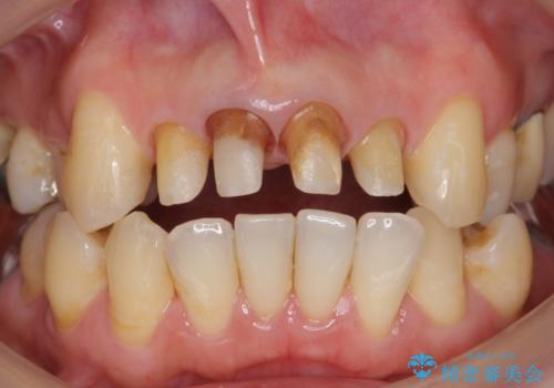 [オールセラミッククラウン]  前歯の黒ずみ　経年変化した差し歯のやりかえの治療中