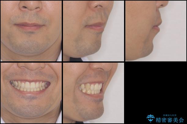 前歯のでこぼこをスッキリと　目立たない装置による抜歯矯正の治療後（顔貌）