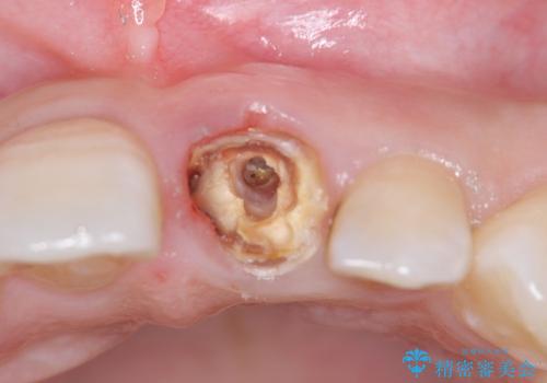 クラウン下に再発した虫歯　審美ブリッジによる補綴の治療前