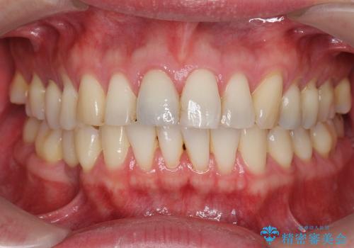 神経の死んだ歯の変色　前歯審美回復セラミック治療の治療後