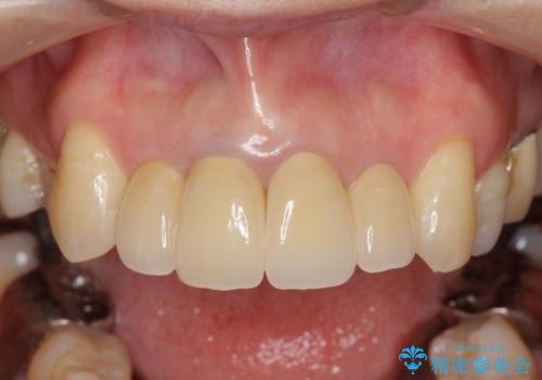 [オールセラミッククラウン]  前歯の黒ずみ　経年変化した差し歯のやりかえの治療後