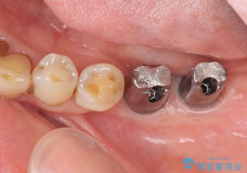 [ 骨造成を伴う臼歯部インプラント治療 ② ]  歯ぐきの移植・チタンカスタムアバットメント・メタルボンドクラウン製作の治療中