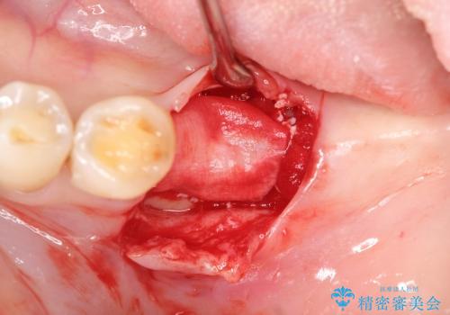 [ 骨造成を伴う臼歯部インプラント治療 ① ]  抜歯を行い骨造成、インプラントの埋入の治療中