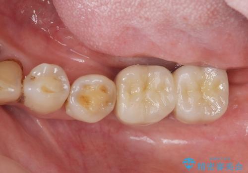 [ 骨造成を伴う臼歯部インプラント治療 ② ]  歯ぐきの移植・チタンカスタムアバットメント・メタルボンドクラウン製作の治療後