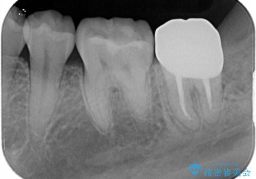 左下奥歯 歯肉の少し下まで虫歯 セラミック治療の治療後