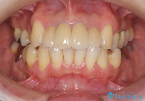 [オールセラミッククラウン]  前歯の黒ずみ　経年変化した差し歯のやりかえの治療後