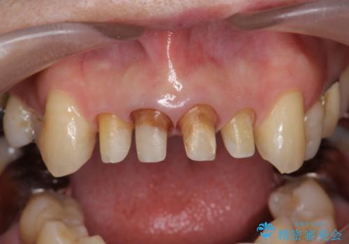 [オールセラミッククラウン]  前歯の黒ずみ　経年変化した差し歯のやりかえの治療中