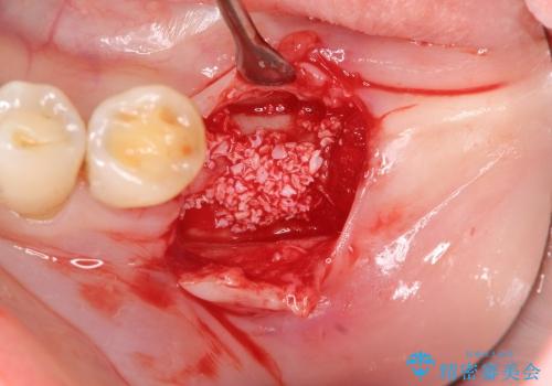 [ 骨造成を伴う臼歯部インプラント治療 ① ]  抜歯を行い骨造成、インプラントの埋入