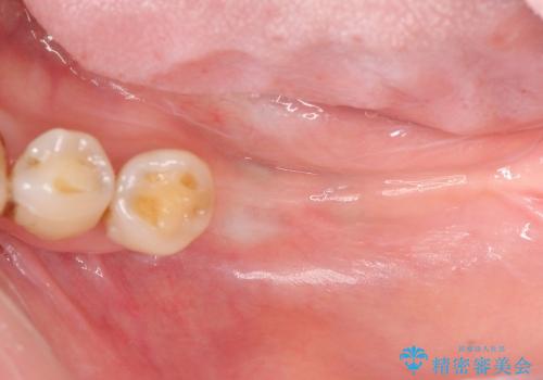 [ 骨造成を伴う臼歯部インプラント治療 ② ]  歯ぐきの移植・チタンカスタムアバットメント・メタルボンドクラウン製作の治療前