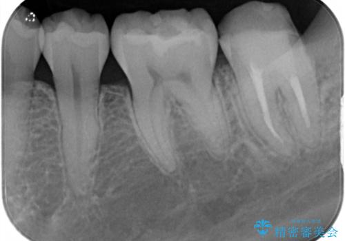 左下奥歯 歯肉の少し下まで虫歯 セラミック治療の治療前