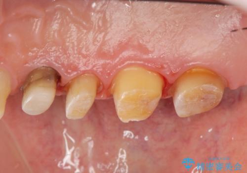 [ジルコニアクラウン] 銀歯を白く　臼歯部メタルフリー治療の治療中