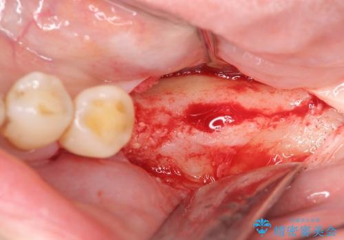 [ 骨造成を伴う臼歯部インプラント治療 ① ]  抜歯を行い骨造成、インプラントの埋入の治療後