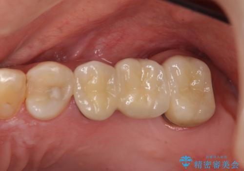 小矯正を併用し清掃性を高めた臼歯部ブリッジの症例 治療後