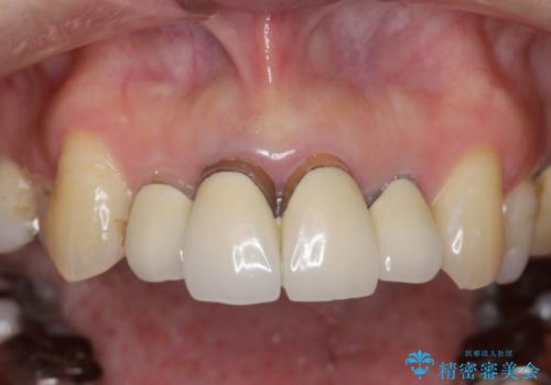 [オールセラミッククラウン]  前歯の黒ずみ　経年変化した差し歯のやりかえの治療前