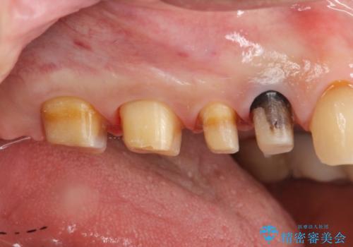[ジルコニアクラウン] 銀歯を白く　臼歯部メタルフリー治療の治療中