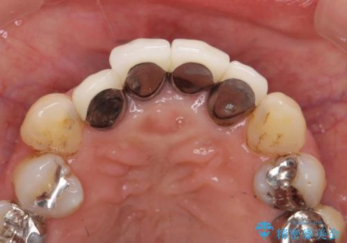 [オールセラミッククラウン]  前歯の黒ずみ　経年変化した差し歯のやりかえの治療前
